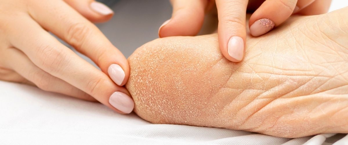 verfahrenstechniken-hornhautentfernung