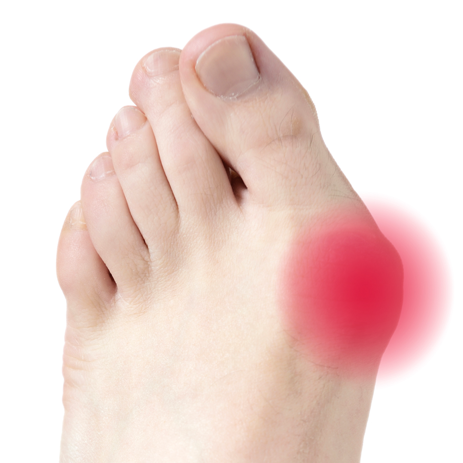 Hallux Valgus - großer Druckschutz aus Gel