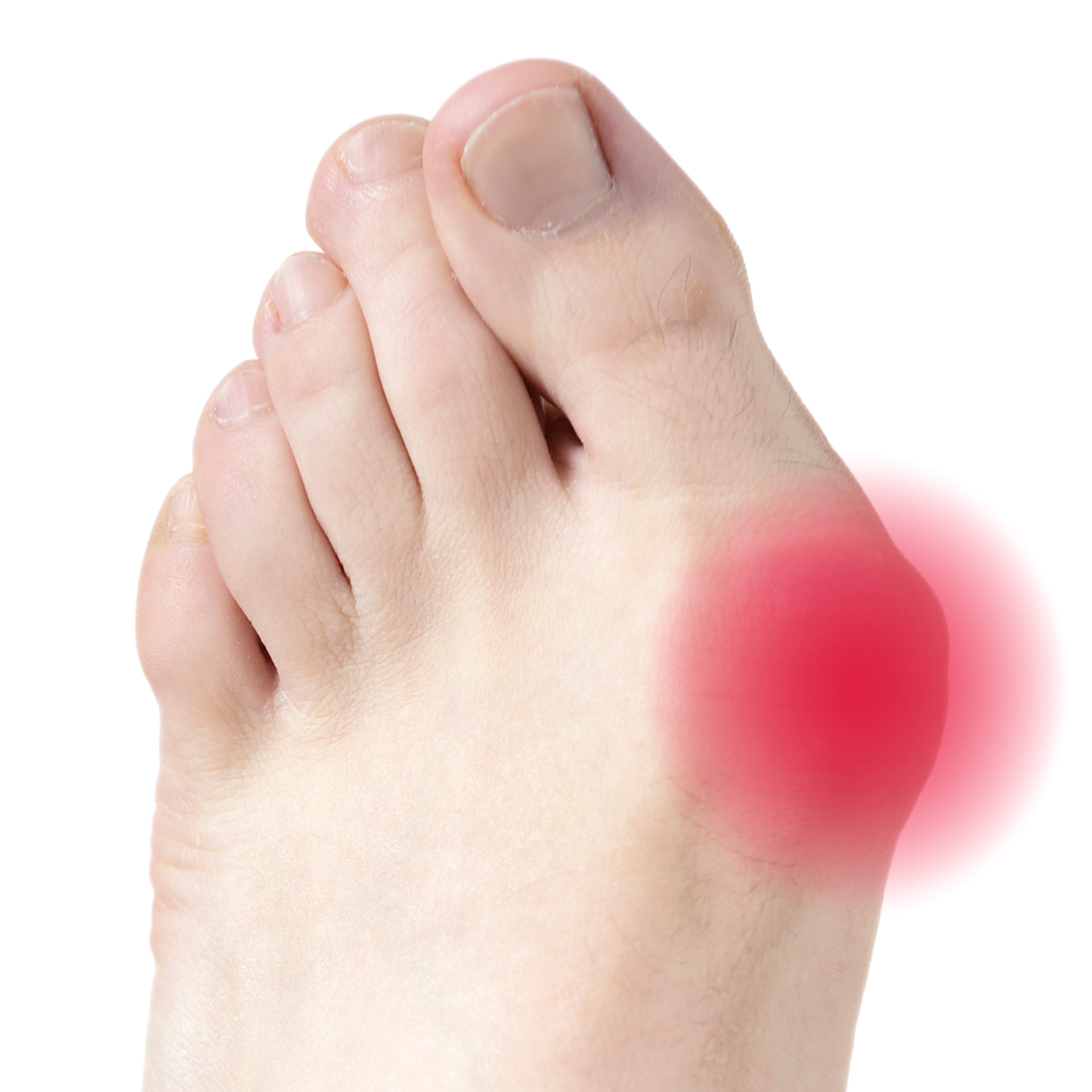 Hallux Valgus Druckschutz aus Polymergel
